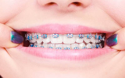 Clínica Dental Sonreimos - Ortodoncia Brackets