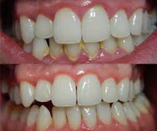 Clínica Dental Sonreimos - Periodoncia La Gingivitis