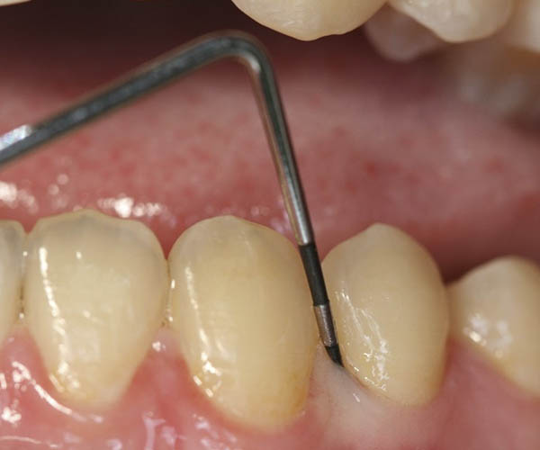 Clínica Dental Sonreimos - Periodoncia La Periodontitis